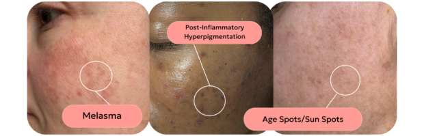 skin with different types of pigmentation