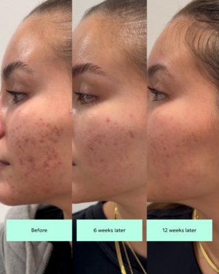 before and after for fading hyperpigmentation with TXA